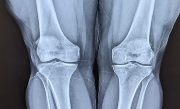 A black and white picture of two knees from an MRI