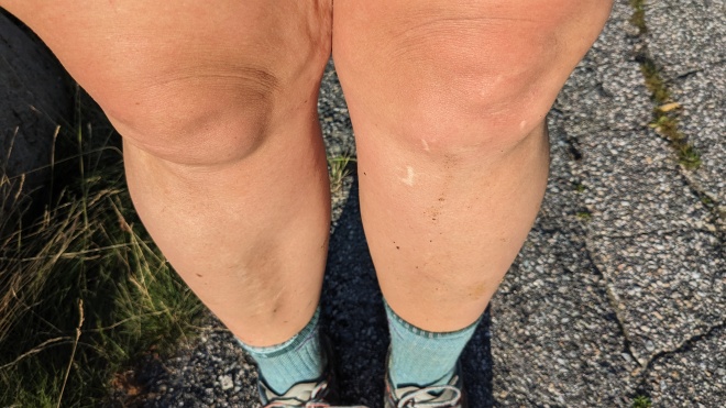 Two dirty knees. One is very swollen.